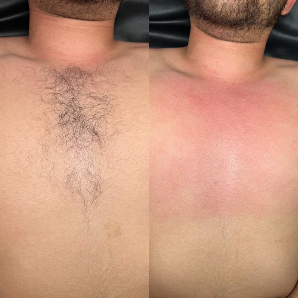 Chest Wax