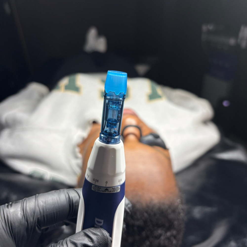 Microneedling - scar at ALL GLOWN UP SKINCARE in Temple Hills, MD