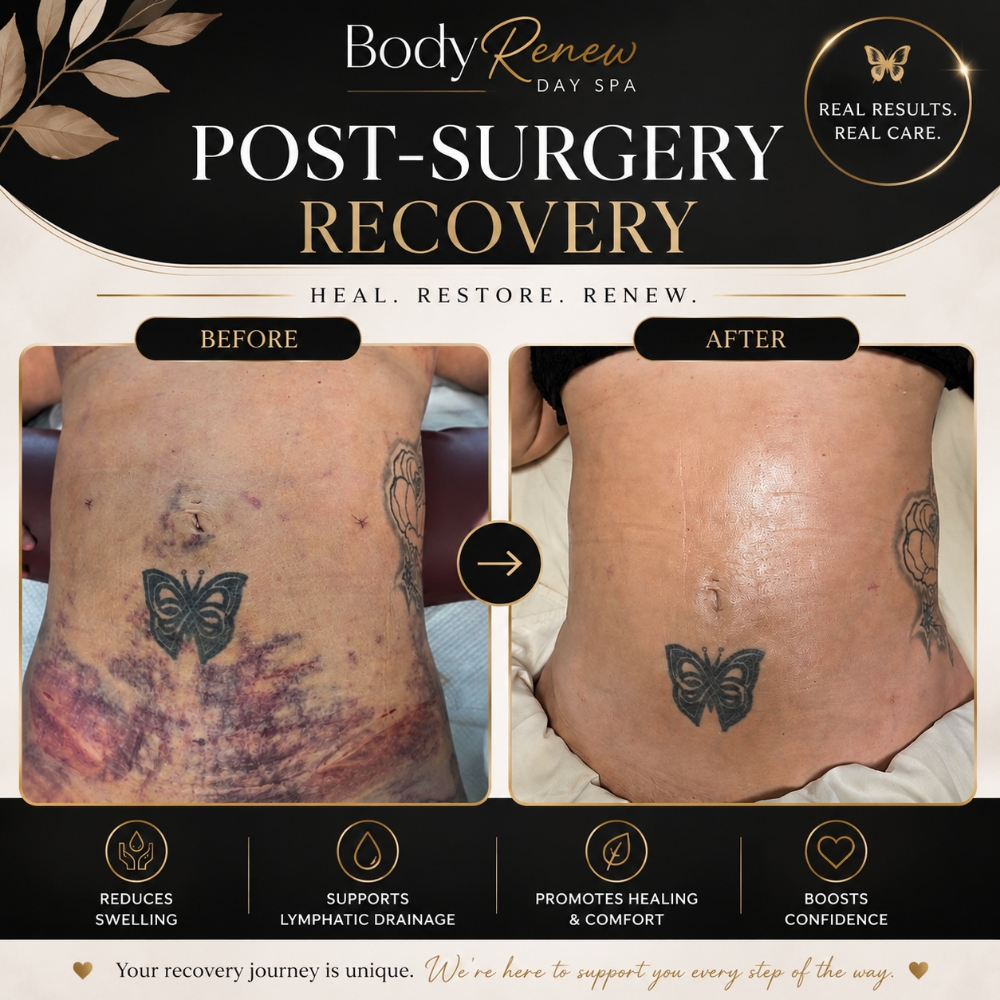 Post-Surgical Lymphatic Drainage at Bodyrenew Day Spa in Naples Fl, FL