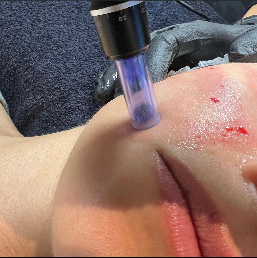 Micro needling