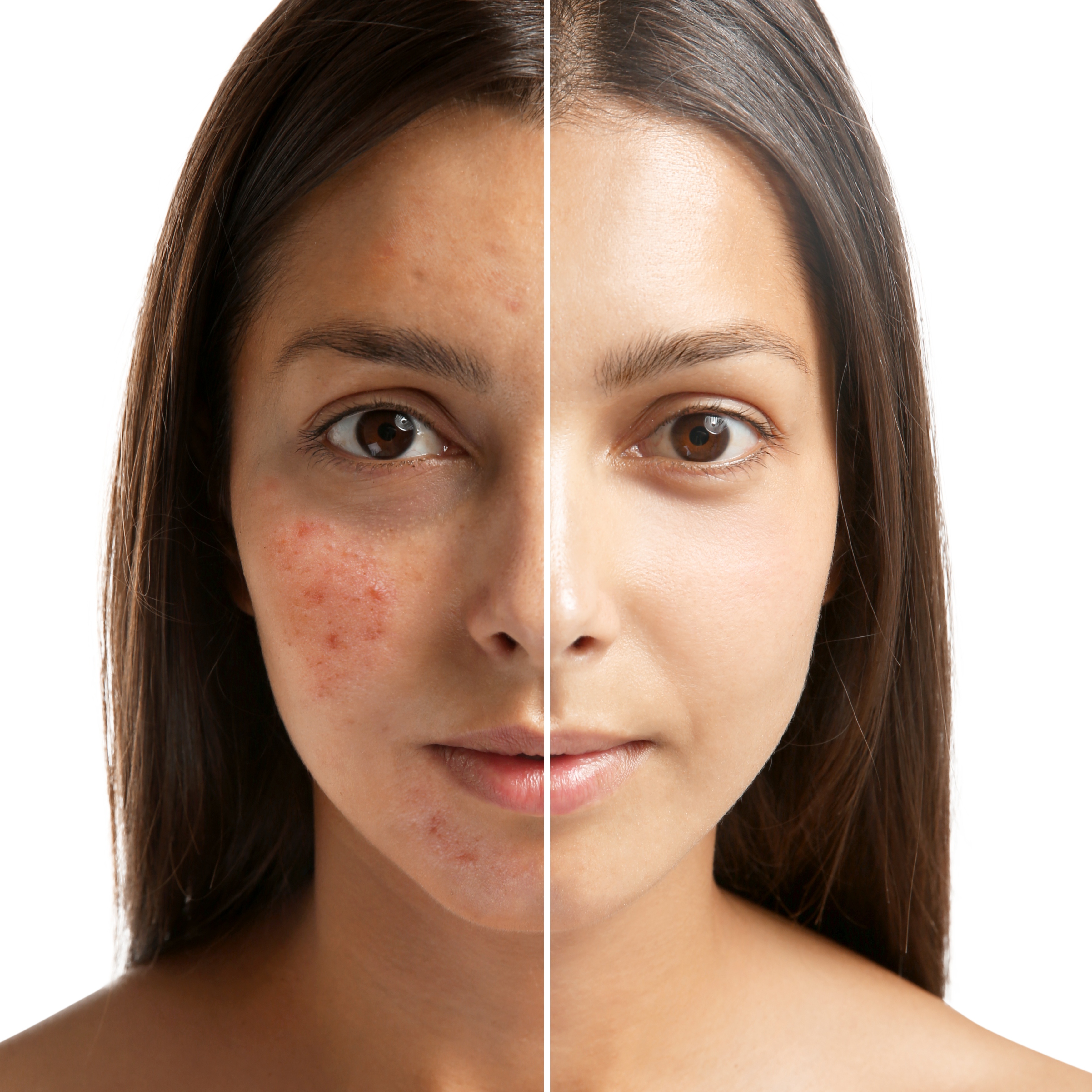 Tratamiento Facial Clear Confidence at Metamorphix Skin in Gaithersburg, MD