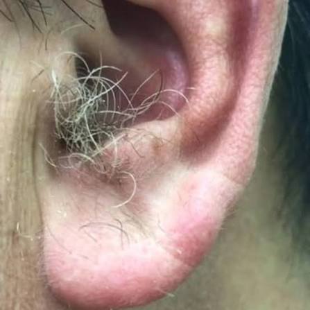 Ear Wax