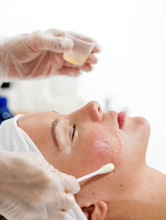 4 Layer Vitamin C Treatment