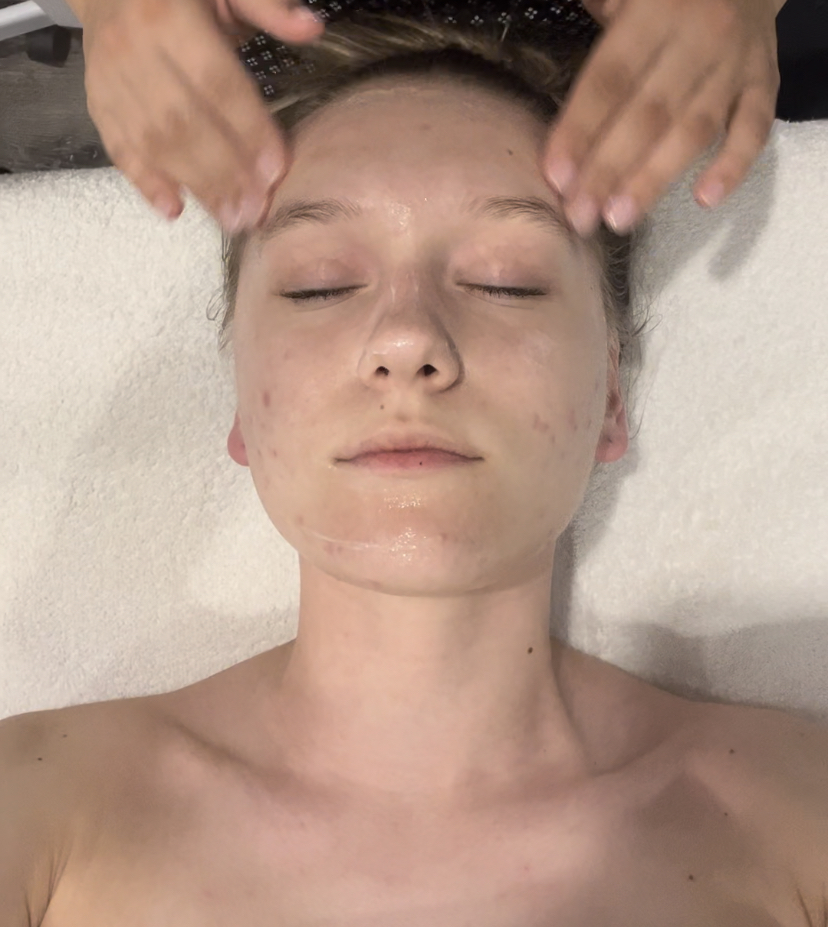 Acne Facial