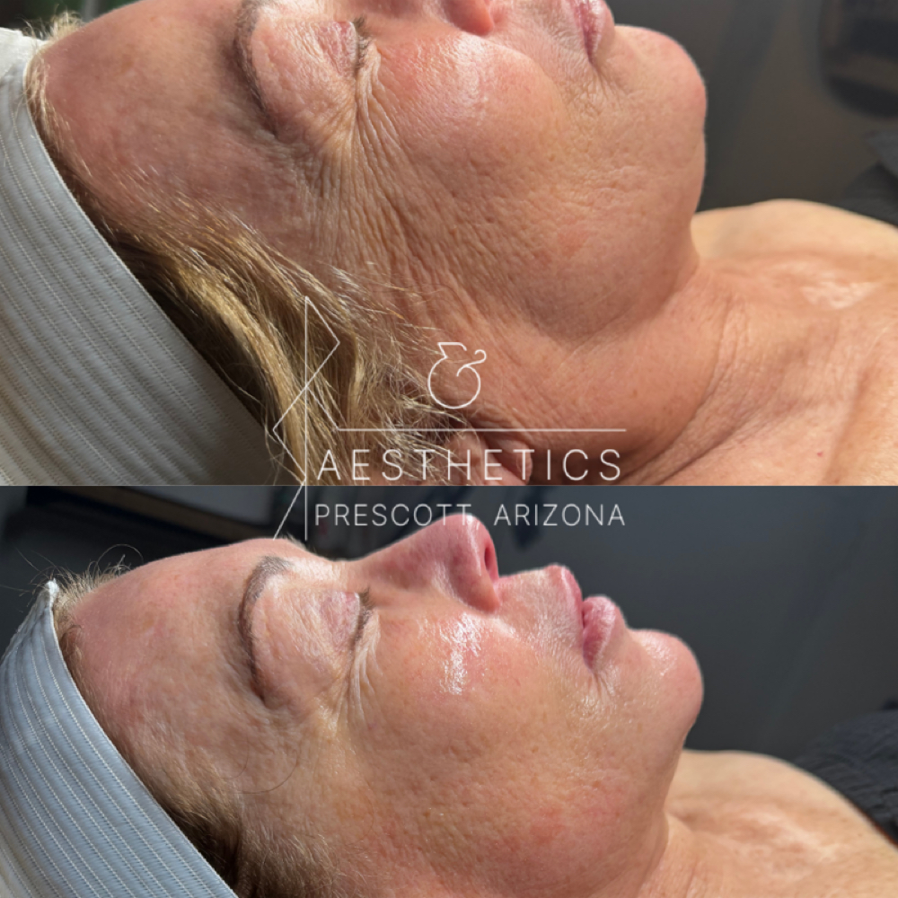Procell Microchanneling Pro at R&R Aesthetics - Prescott, Arizona in Prescott, AZ
