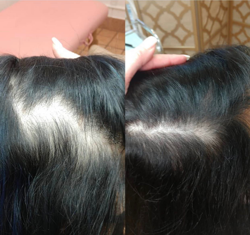 Hair Treatment Pkg 5 - crown