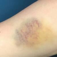 Bruising, Wound Healing Laser