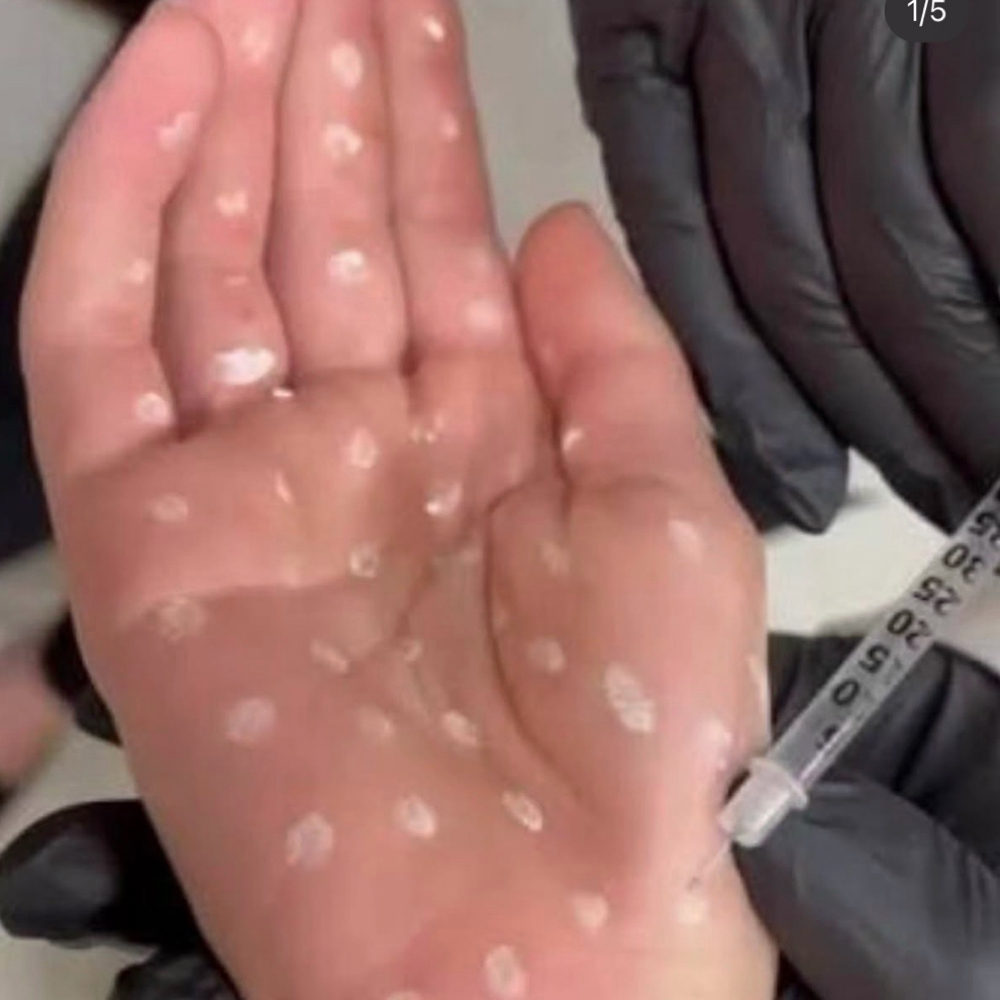 Hyperhidrosis Injections • Kensey at Vibez & Vanity Salon in Tucson, AZ