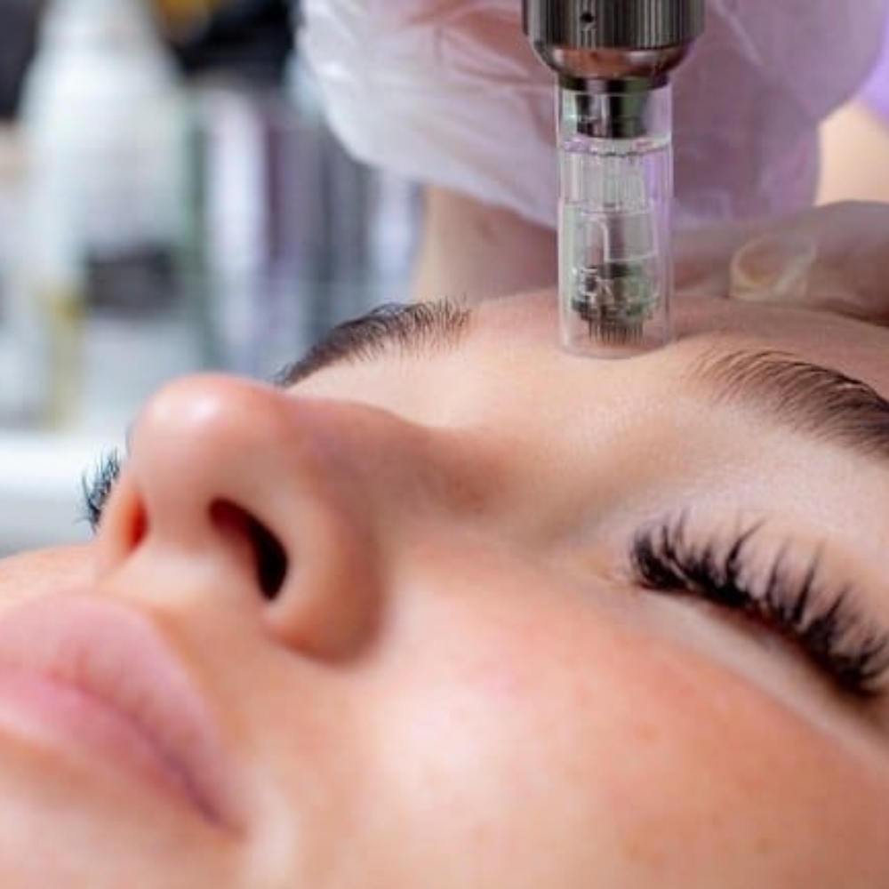 Skin Renewal Microneedling at Skintherapy in Framingham, MA