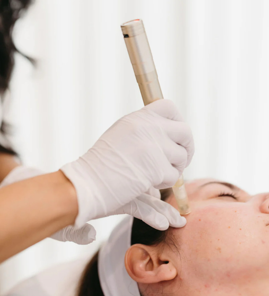 Exosome Microneedling Face
