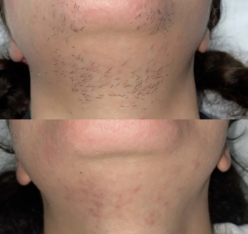 Full Face Wax