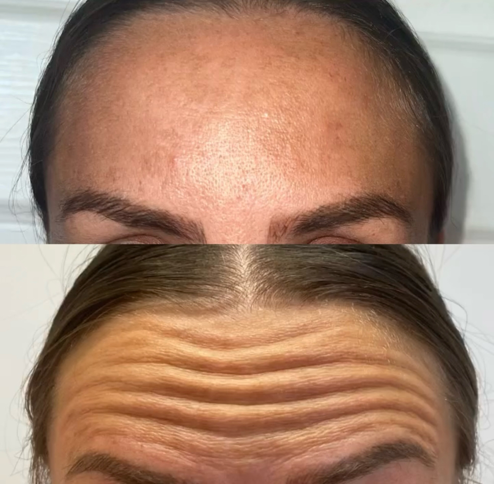 Full Face Botox