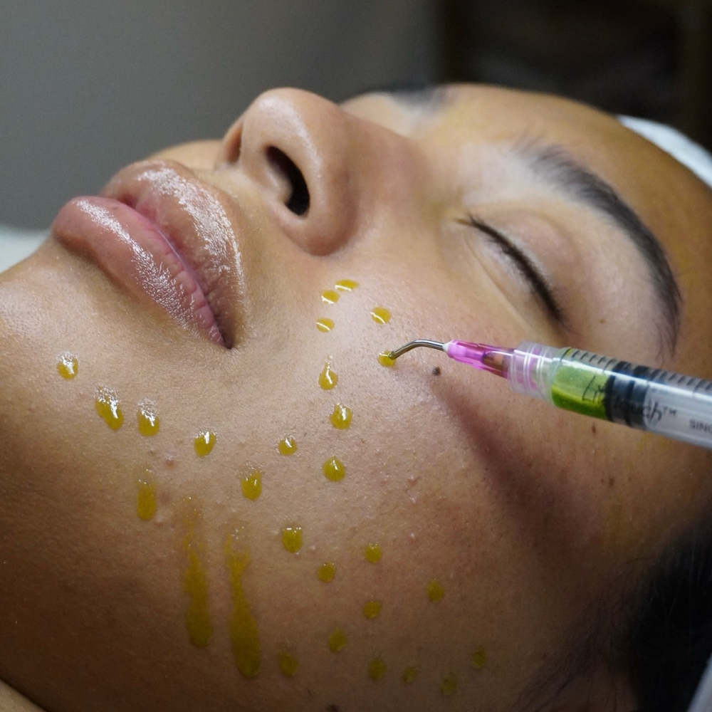BioRePeel: “The Green Magic Peel” at Cora Esthetics in Lubbock, TX