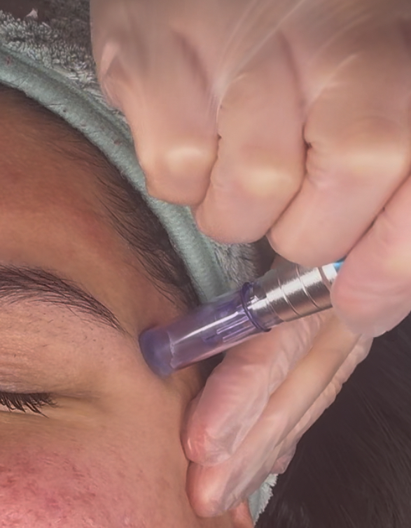 Nano Infusion Treatment Package