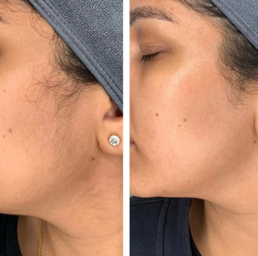 Dermaplaning Facial
