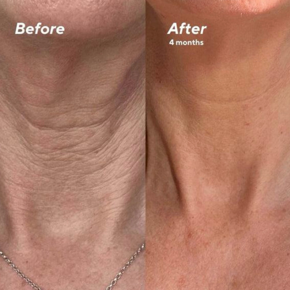 Firming Neck Treatment at Lumeva Aesthetic L.L.C in Maryland, MD