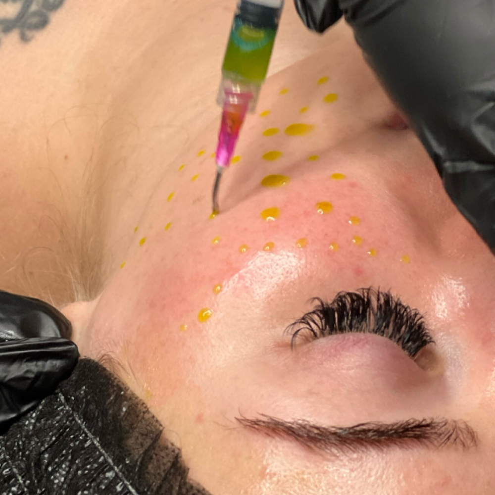 NEW- BioRePeel -ZERO downtime Peel at Orion Beauty in Cincinnati, OH