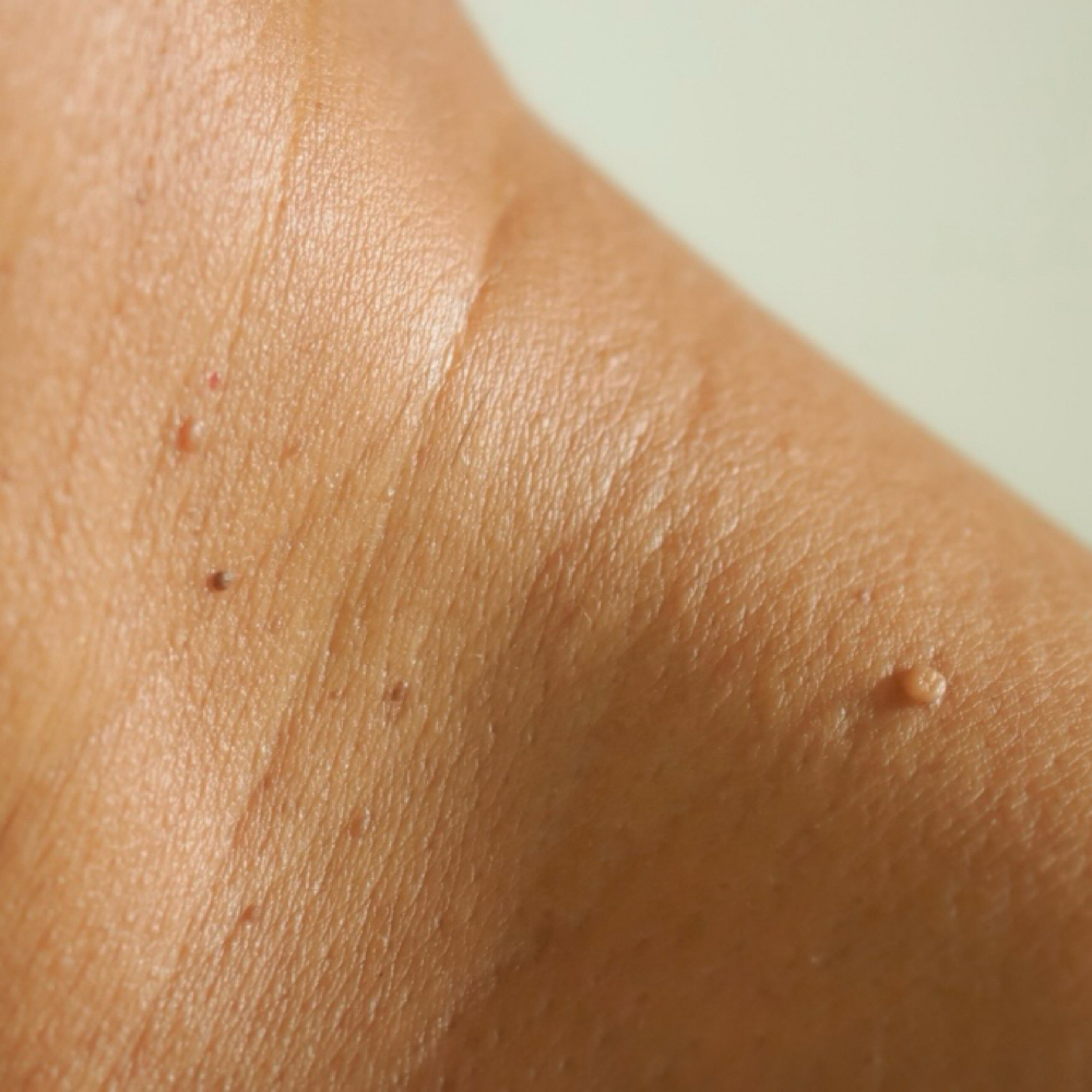 Skin Tag Removal at Bliss Beauty Spa in Thomaston, ME