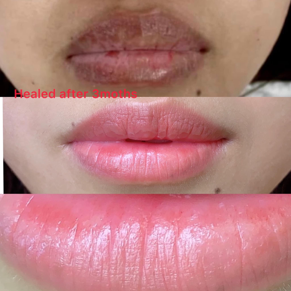 Lip Collagen