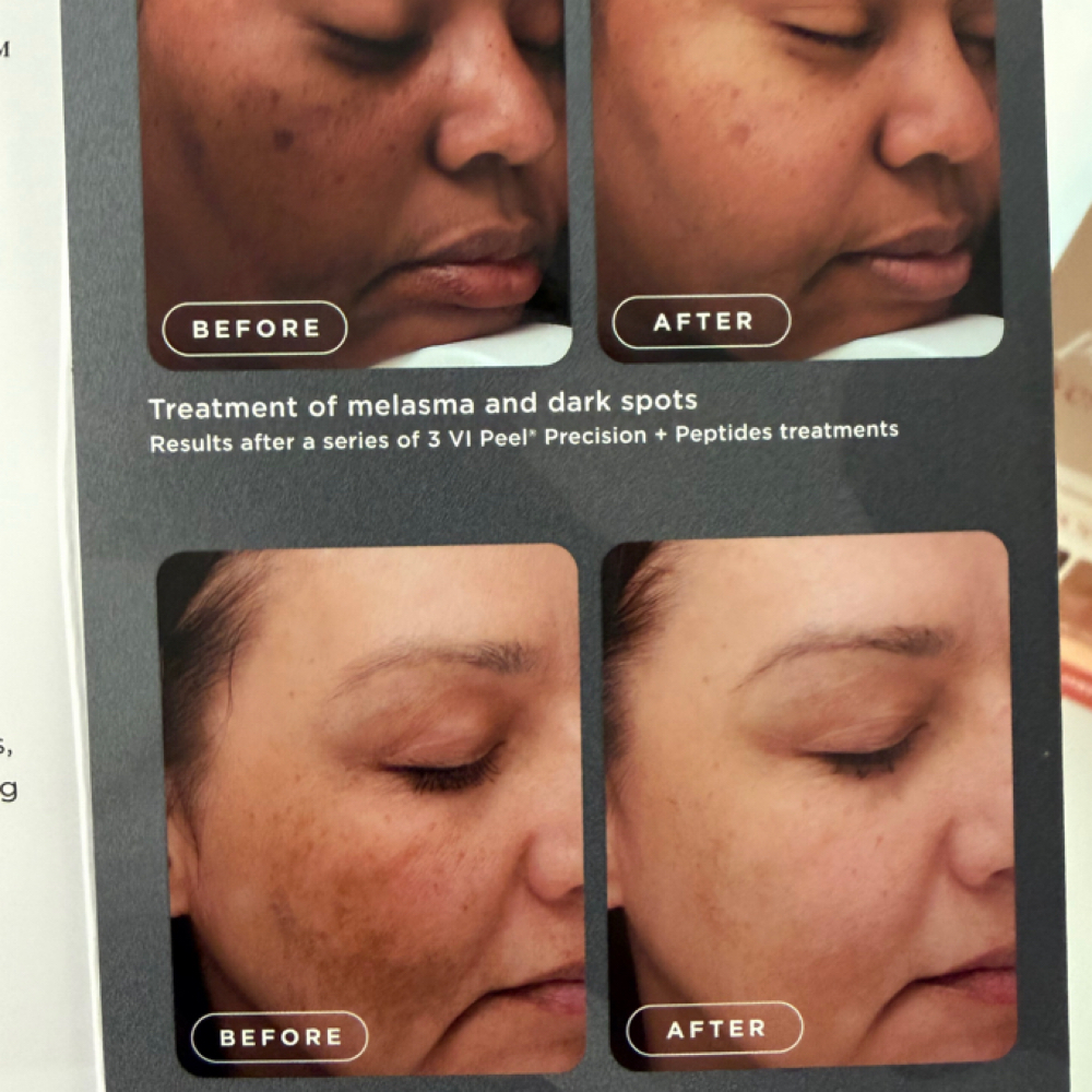 VI Peel (Introductory) at 1111 Aesthetics & Wellness LLC in Irving, TX