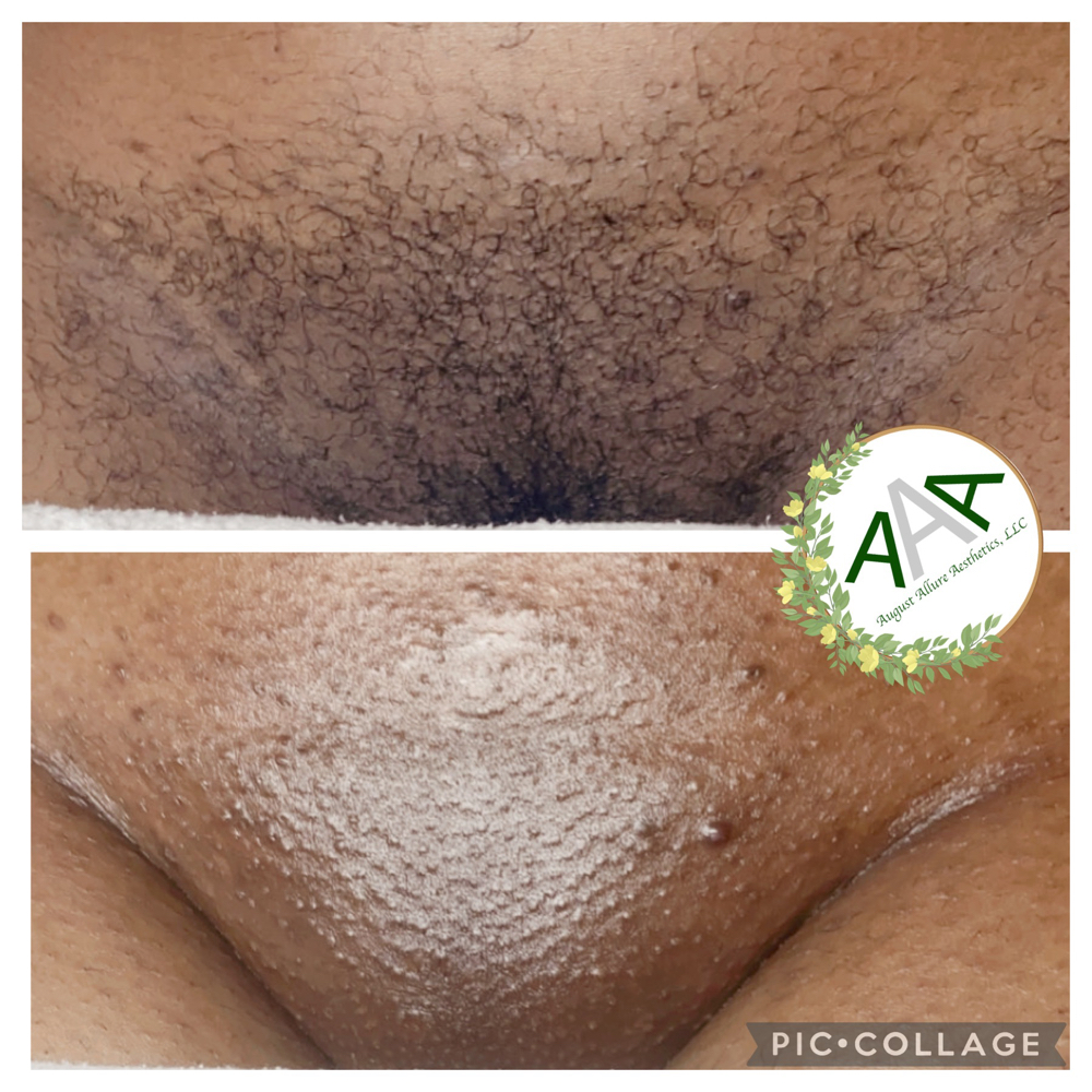 Bikini Full Front at August Allure Aesthetics LLC in Lehigh Acres, FL