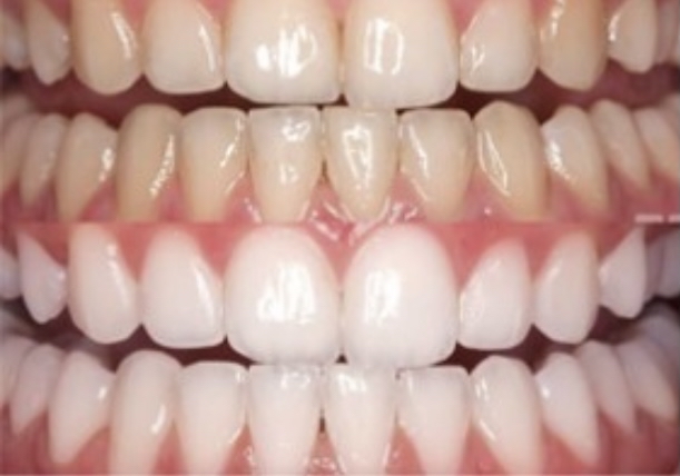 Laser Teeth Whitening