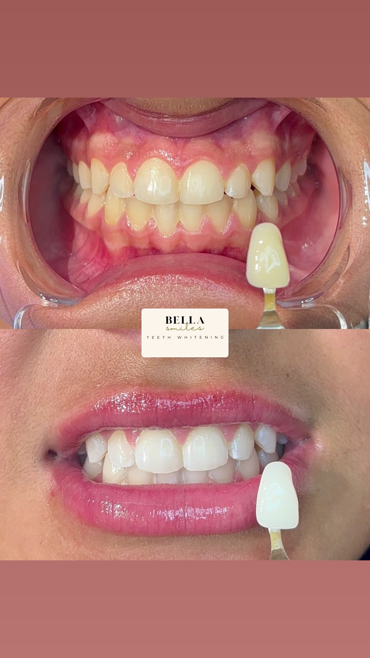 New Teen Whitening Sessions