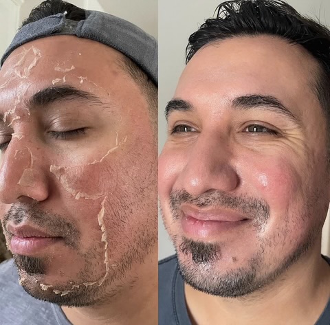Chemical Peel