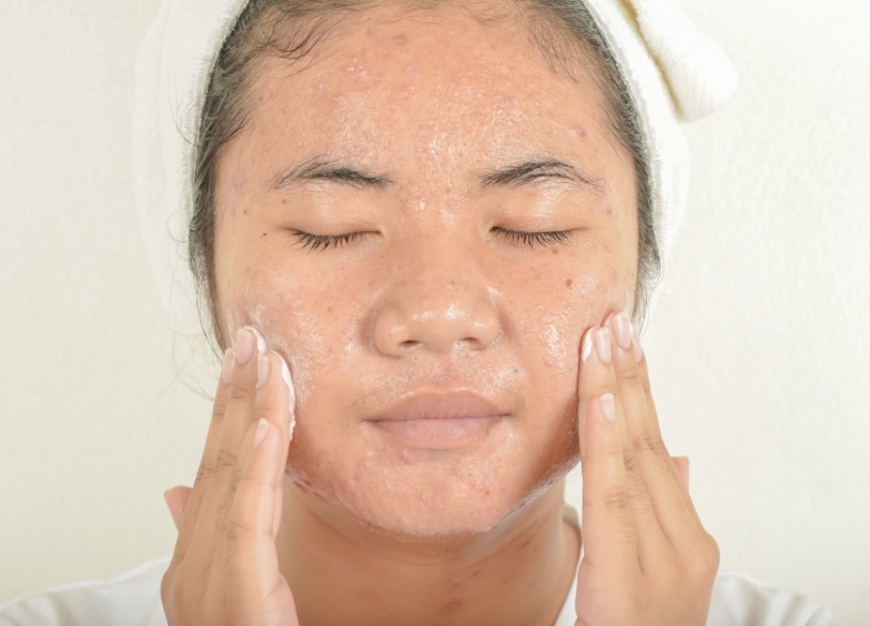 Acne Facial