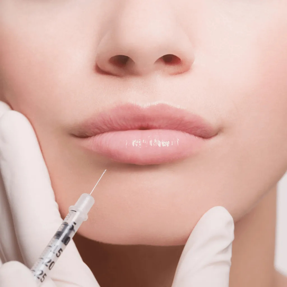 Dermal Filler - Restylane Kiss/Lyft