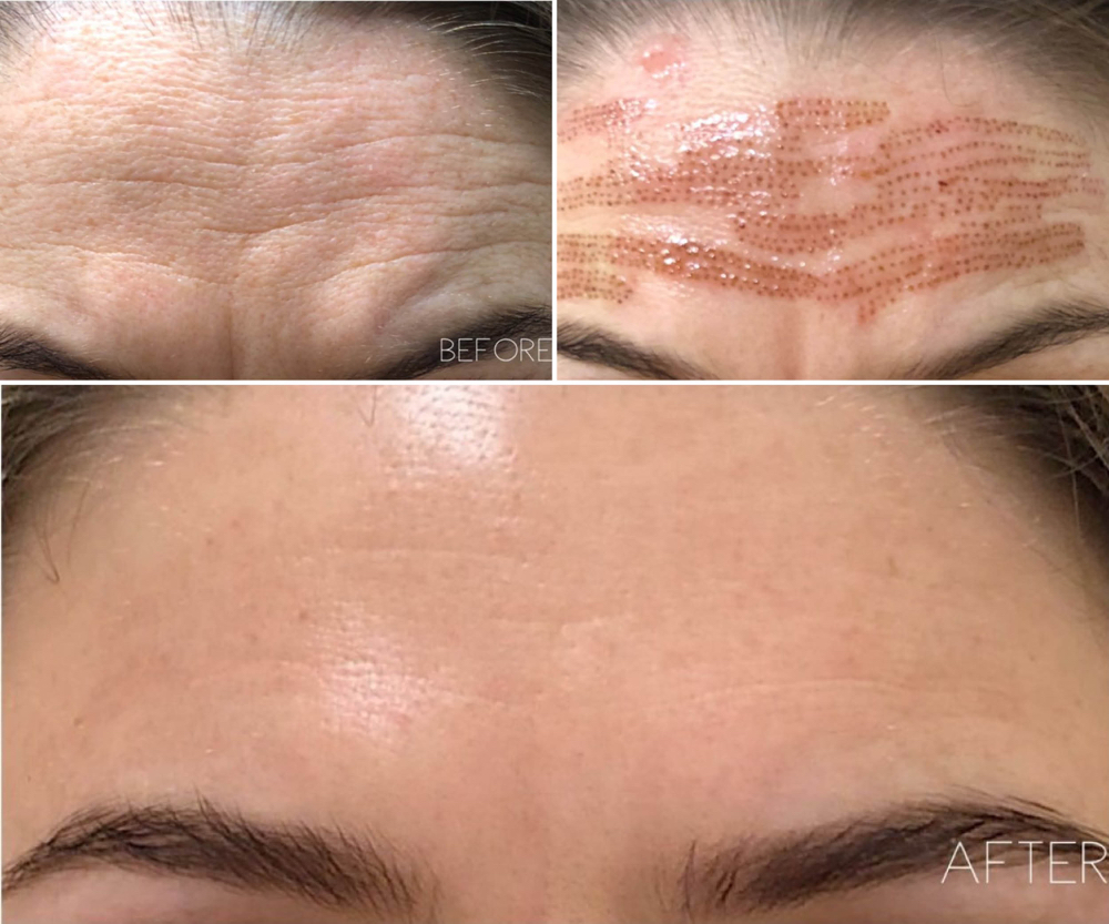 Fibroblast Forehead Lines