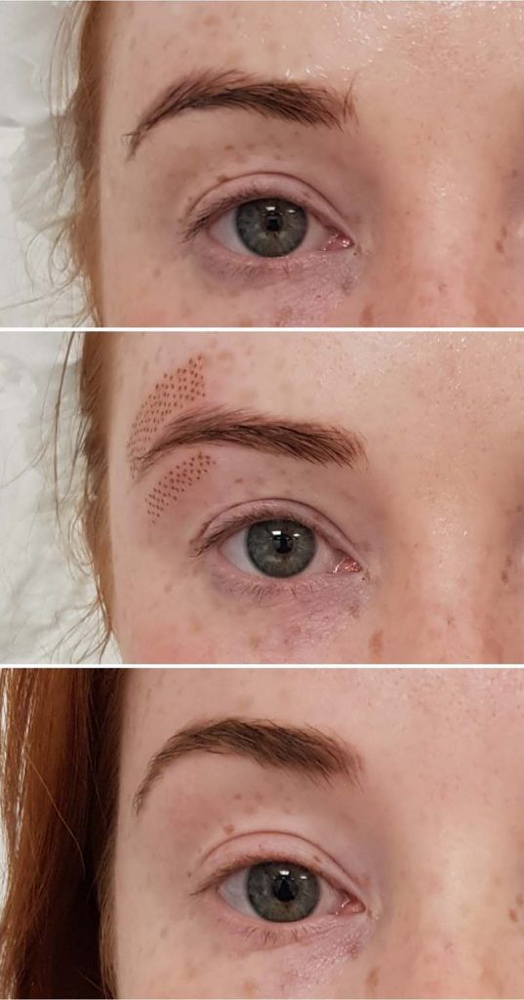 Fibroblast Brow Lift
