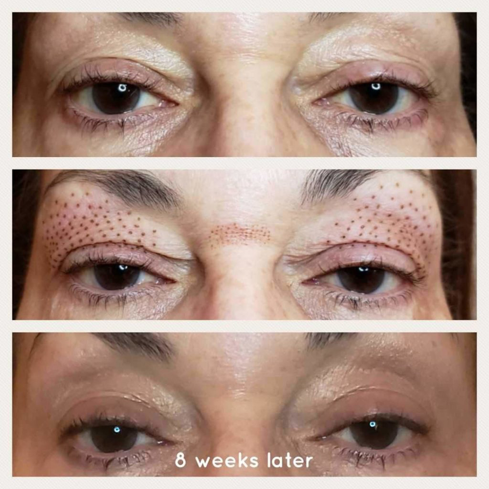 Fibroblast Hooded Eye Lift