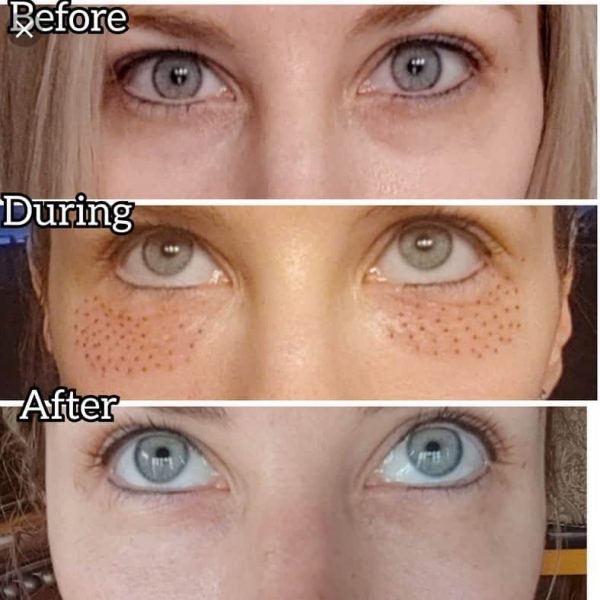 Fibroblast Under Eye