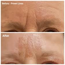 Fibroblast Frown Lines