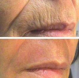 Fibroblast Smokers Lines