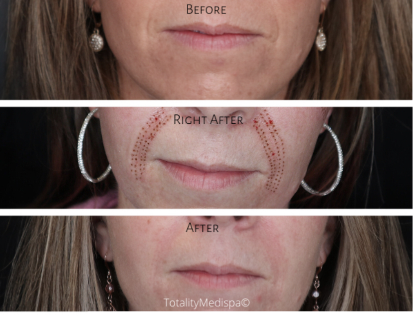 Fibroblast Nasolabial Folds