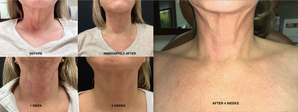 Fibroblast Neck Lift