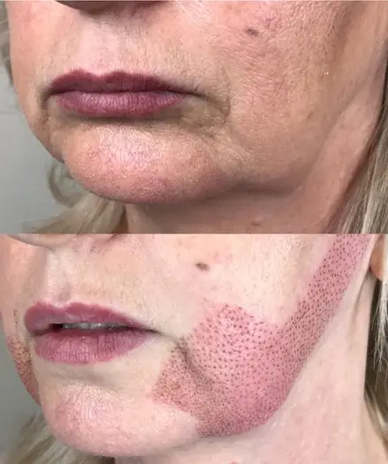 Fibroblast Jowl Tightening