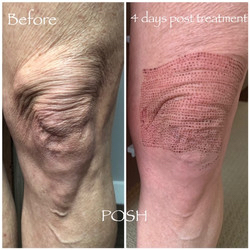 Fibroblast Knees