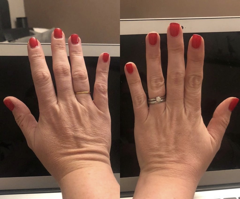Fibroblast Hands