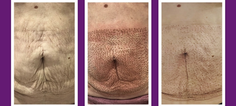 Fibroblast Tummy Tightening
