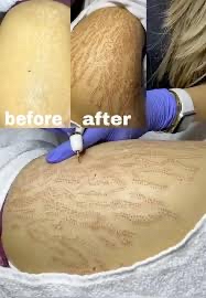 Fibroblast Stretch Mark Reduction
