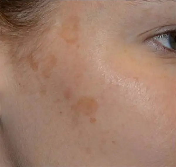 Age Spot Removal