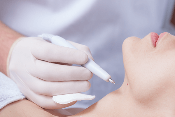 Skin Tag Removal
