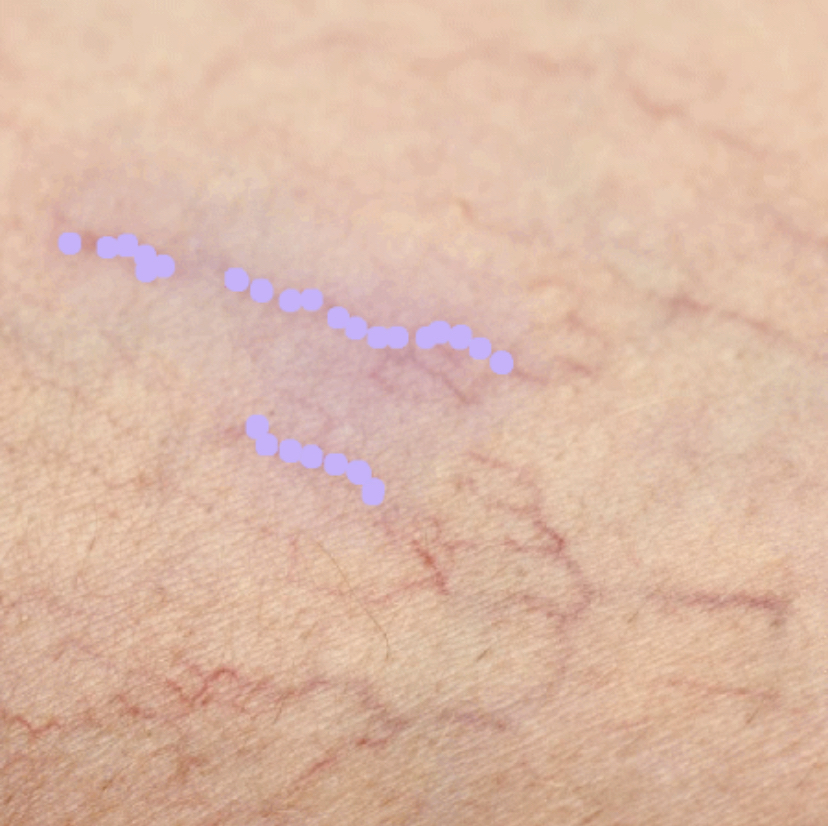 Fibroblast Telangiectasia Removal