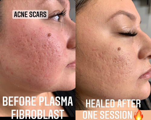 Acne Scars