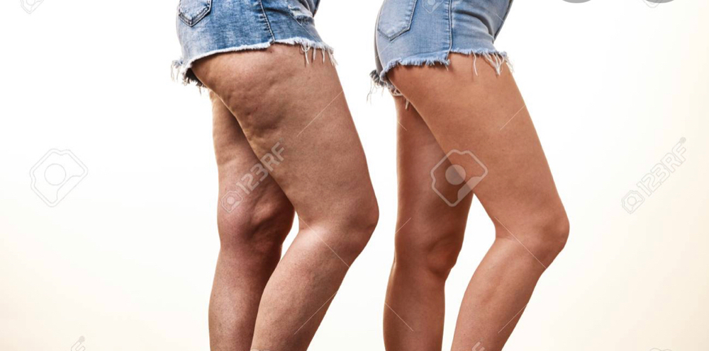 Conquer Cellulite