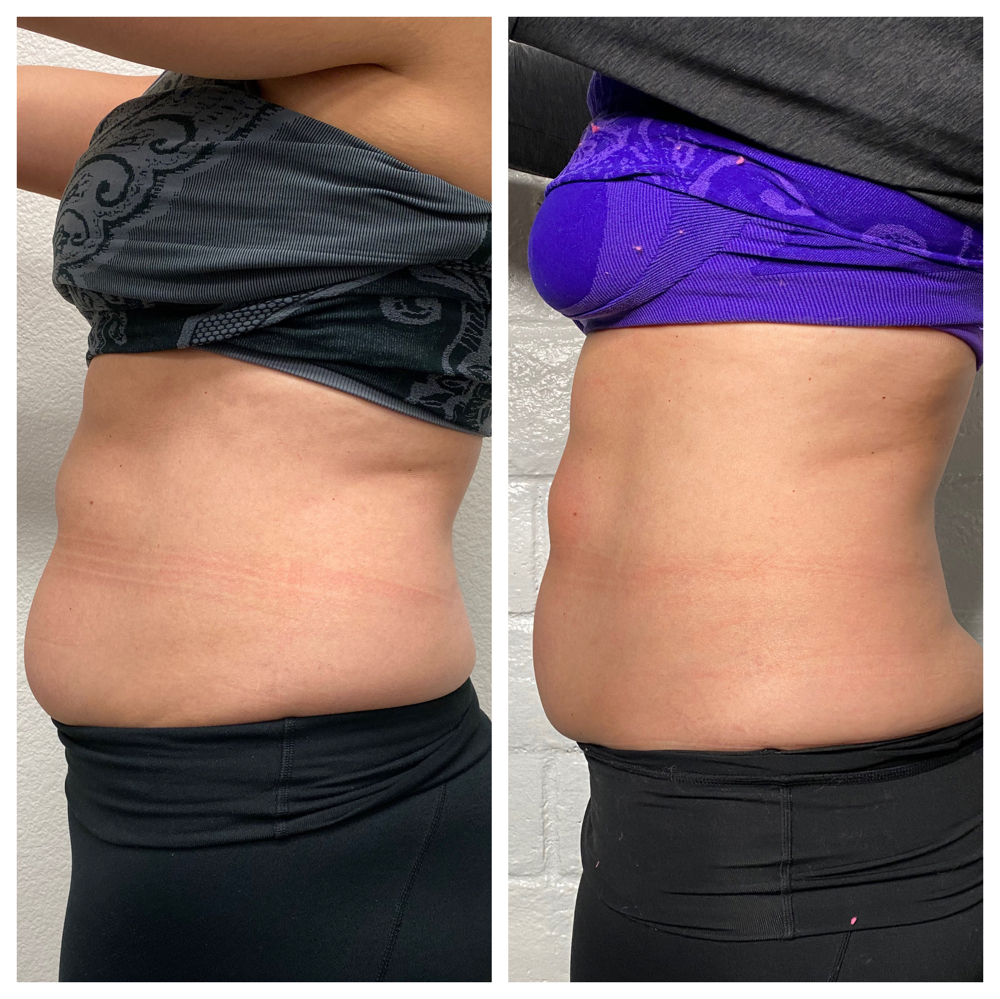 Body Sculpting - Full Contour Apt