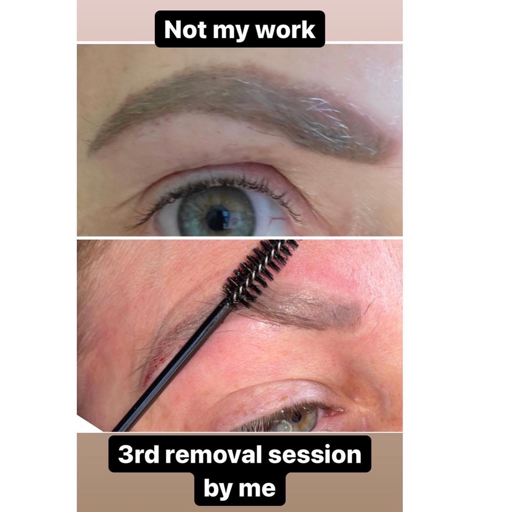 Brow Tattoo Removal (each Session)